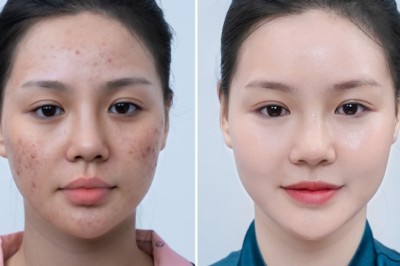 ĐIỀU TRỊ NÁM – CHẠY HOÀI KHÔNG RA KHÁCH, VÌ CHƯA CHẠM ĐÚNG NỖI SỢ!