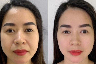 TIÊM FILLER – QUẢNG CÁO CÓ LƯỢT NHƯNG KHÔNG RA KHÁCH!